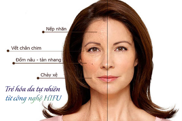 Nâng cơ - xóa nhăn bằng công nghệ hifu