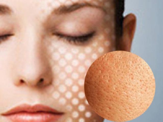 ĐIều trị sẹo rỗ, xóa nám, mờ thâm bằng phương pháp lăn kim